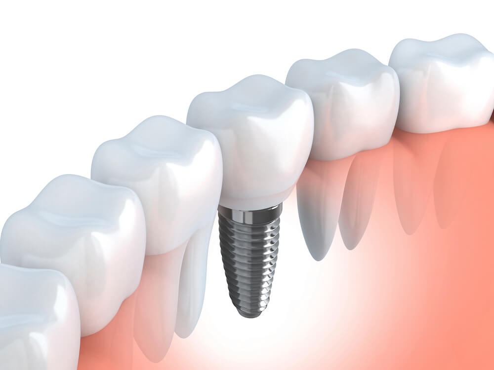 Ile kosztują implanty zębów?